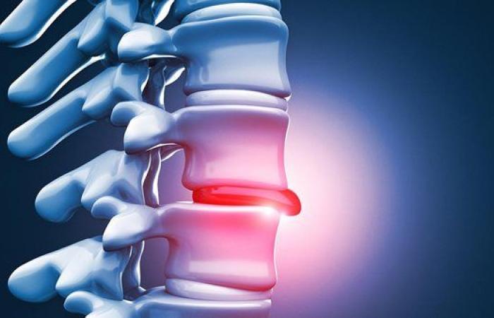 دراسة: أسرار جينية قد تحدث ثورة في علاج ألم العصب الوركي