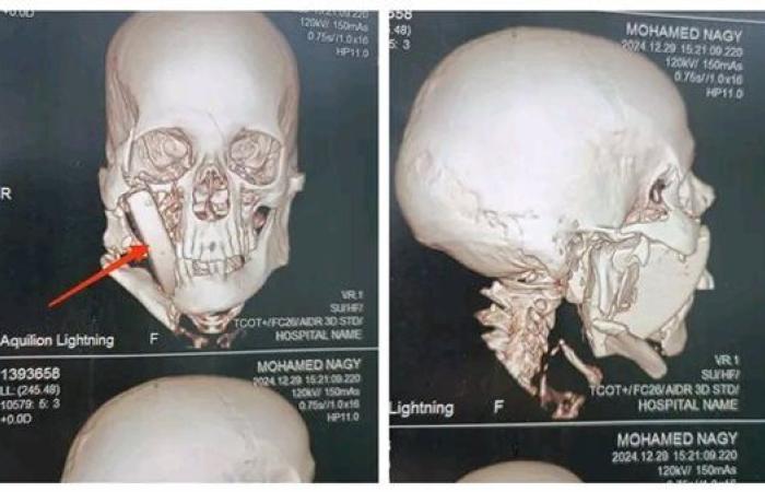 جامعة أسيوط تنجح في إجراء عملية إزالة قطعة حجرية داخل وجه مريض 